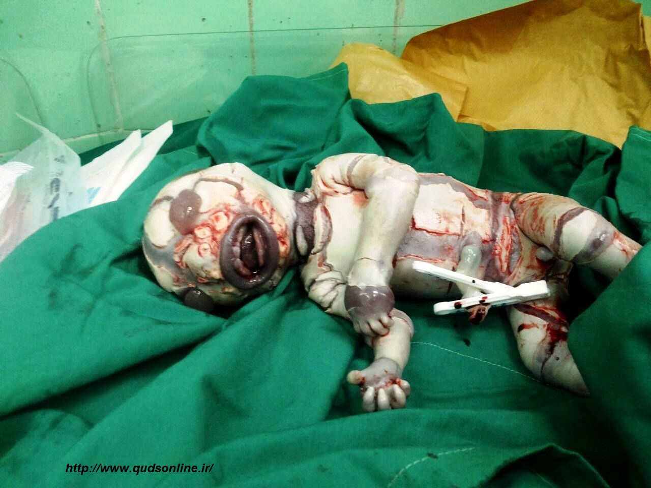 تولد نوزاد مبتلا به ایکتیوز نادر در داراب استان فارس(عکس +18)