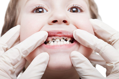شیوع پوسیدگی دندانها در سنین بالای 20 سال