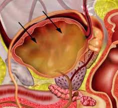 ۶۰ درصد تمامی سرطان‌ها قابل پیشگیری هستند/رشد سرطان پستان در بانوان ایرانی بیشتر است