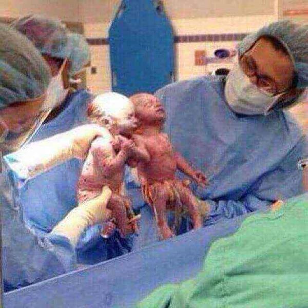 دوقلوهایی که تا لحظه به دنیا آمدن، دستان یکدیگر را رهانکردند/عکس