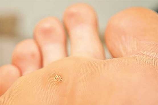 مانند میخ در کف پا!