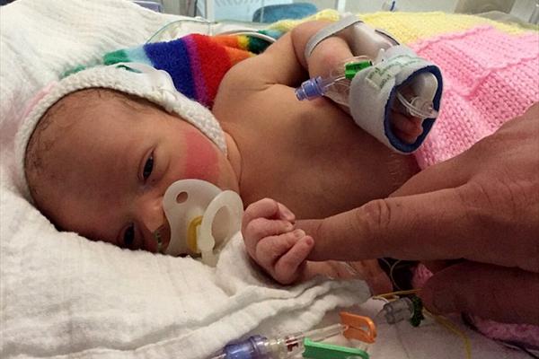 تولد نوزادی با روده خارج از بدن+ عکس