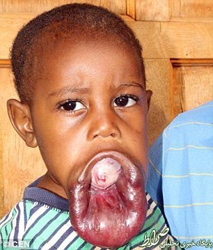 رشد غیر طبیعی دهان یک کودک + عکس