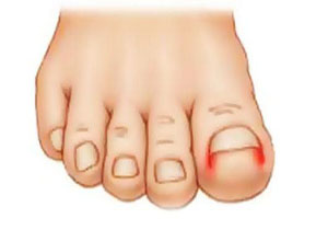فرو رفتن ناخن پا در گوشت را جدی بگیرید