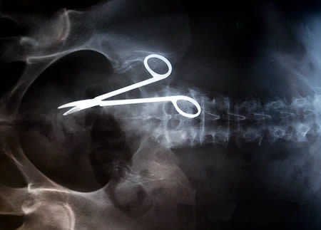   جراح همداني قیچی را در شکم بيمار قمي جا گذاشت / پس از یک ماه قیچی از بدن بیمار خارج شد