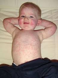 علایم ابتلا به «روزئولا» در کودکان/ نوعی بیماری‌ از خانواده تبخال که سبب تشنج می‌شود