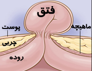 وقتی ناف از محل خود خارج می‌شود / نقش یبوست در بروز فتق های جدار شکم