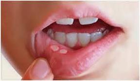 روش های طبیعی و مؤثر درمان " آفت دهان"