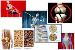 ۳ راه طبیعی برای پیشگیری از پوکی استخوان
