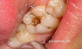 با این ۵ اقدام کرم‌خوردگی دندان را برطرف کنید