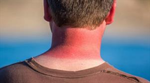 آفتاب سوختگی؛ درمان های خانگی موثر