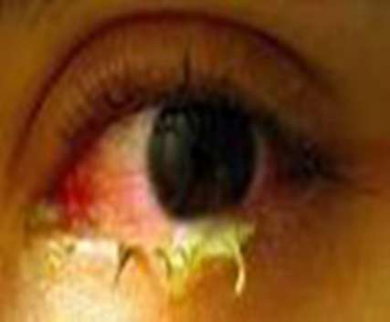 عفونت آدنو ویروسی چشم را جدی بگیرید