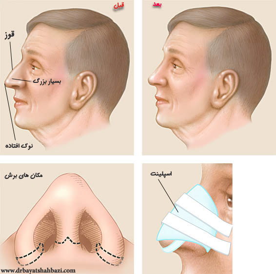 همه چیز درباره جراحی زیبایی بینی