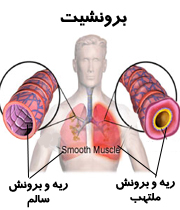 درباره برونشیت مزمن چه می‌دانید؟