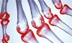 بیماری آرتریت روماتوئید چیست؟