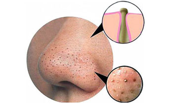 از منافذ باز روی بینی تان نترسید!!