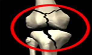 7 توصیه برای مقابله با پوکی استخوان