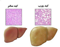 کبد چرب یکی از عوامل بیماری قرن