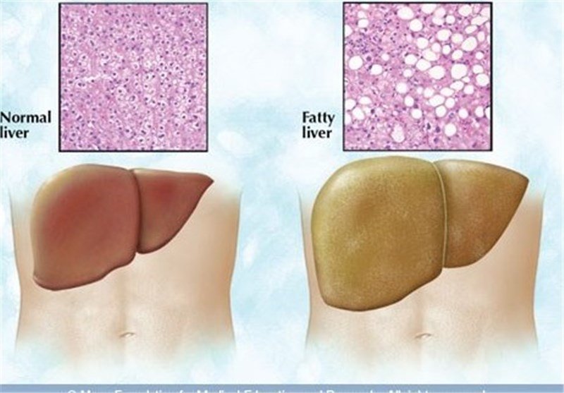 کبد چرب، بیماری خاموش و پیش‌رونده