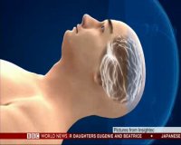 امواج صوتی به جای تیغ جراحی برای اولین بار در انگلیس 