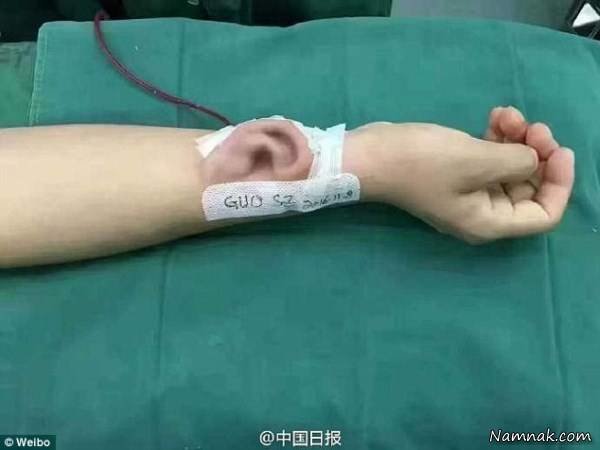 کاشت گوش مصنوعی بر بازوی بیمار
