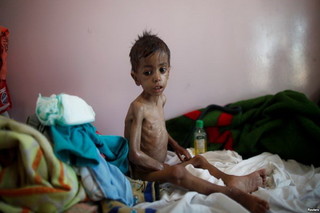 بیش از ۶۰ هزار «کودک» یمنی به بیماری وبا مبتلا هستند