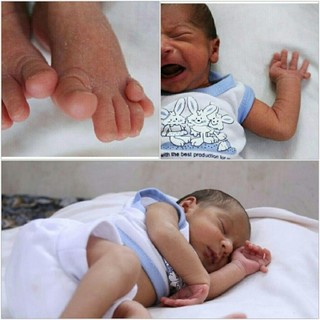 کودک ۲۴ انگشتی در مشهد تحت درمان قرار می‌گیرد