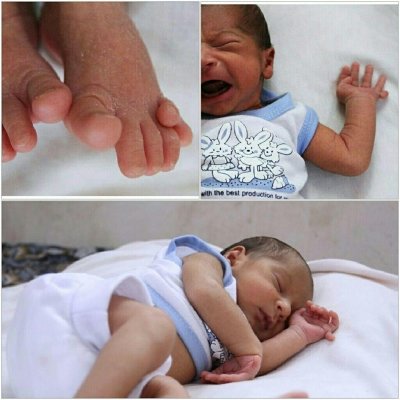 کودک ۲۴ انگشتی در مشهد تحت درمان قرار می‌گیرد