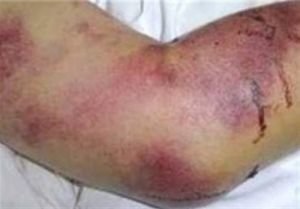 شناسایی 6 مورد مبتلا به تب کریمه کنگو در خراسان رضوی