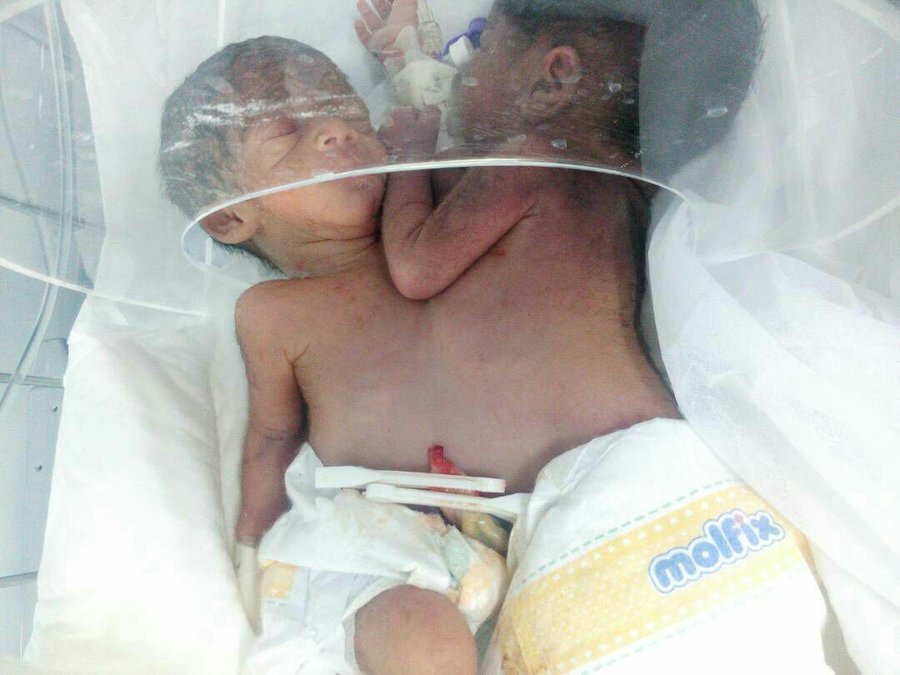 دوقلوهای بهم چسبیده در بیمارستان ۲۲بهمن نیکشهر متولد شدند