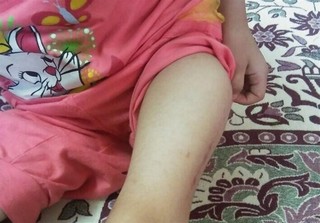 «تانیا» دختر افغانستانی تحت درمان قرار می‌گیرد