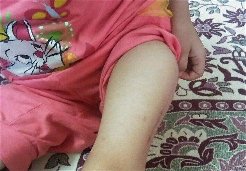 «تانیا» دختر افغانستانی تحت درمان قرار می‌گیرد
