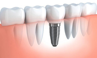راهکار جدید برای تشخیص التهاب ایمپلنت دندان