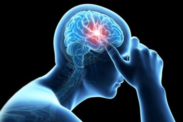 بهبود عوارض «سکته مغزی» به کمک جراحی فوری