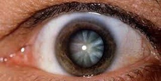 تغییرات مکرر نمره چشم نشانه چه بیماری است؟ 

