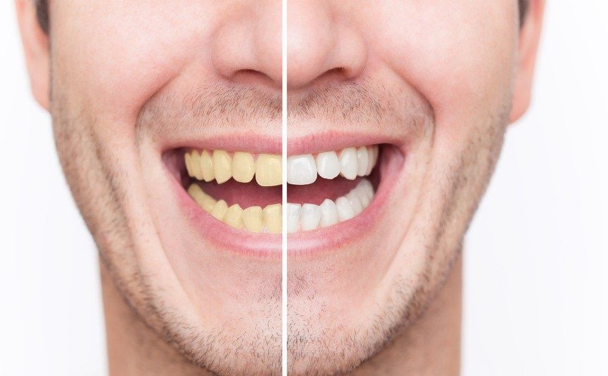 ۱۴ ترفند سفید کردن دندان‌ها در خانه+ عکس