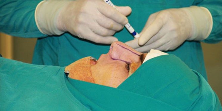  ۶۰ تا ۷۰ درصد مراجعه‌کنندگان برای جراحی بینی نیاز به جراحی ندارند