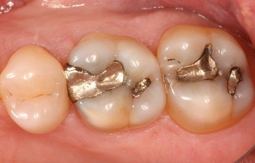 عفونتی خطرناک که در دندان هایتان نهفته است
