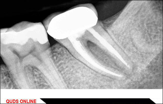چگونه از ریشه دندان‌ها در برابر آفات محافظت کنیم؟