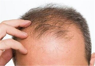 تبلیغ غیرقانونی محصول درمان ریزش موی «ب» در صدا و سیما