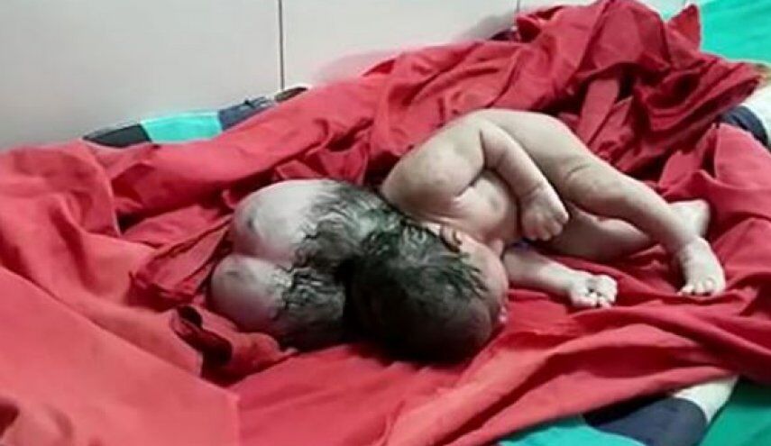 نوزادی که با 3 سر در هند به دنیا آمد+عکس