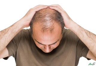 ریزش موی ناشی از ویروس کرونا دائمی نیست