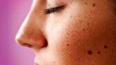 ۷ عاملی که باعث بروز لکه‌های تیره روی پوست می‌شود 