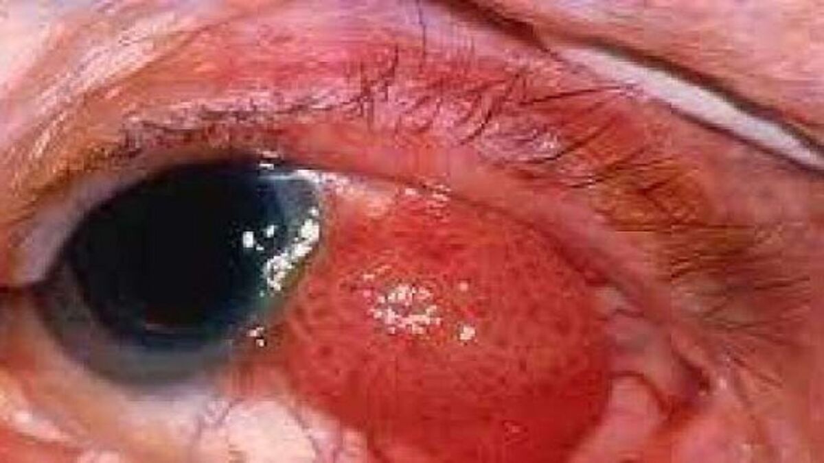 علائمی که نشان دهنده ابتلا به سرطان چشم هستند
