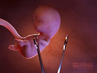 اجباری در سقط درمانی برای مادر دارای جنین ناقص‌الخلقه وجود ندارد