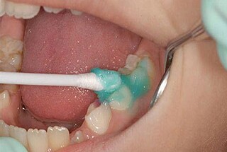 ۳۷ درصد کودکان خراسان رضوی زیر پوشش طرح بهداشت دندان قرار گرفتند