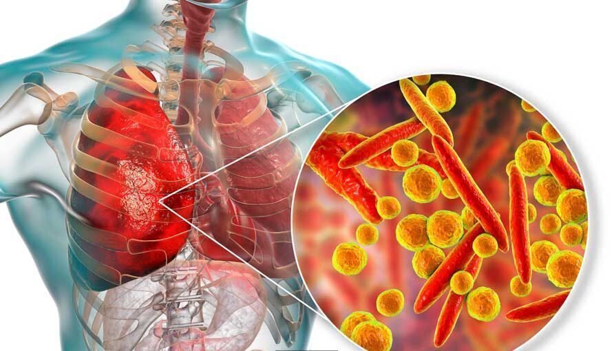 ذات الریه سالانه بیش از یک میلیون قربانی کودک می‌گیرد