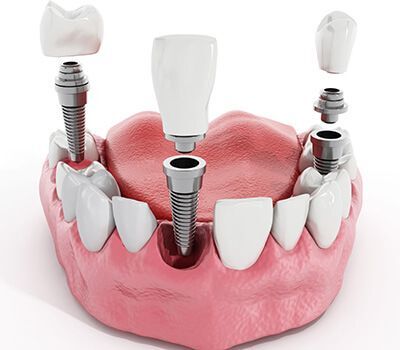آیا ایمپلنت دندان درد دارد؟