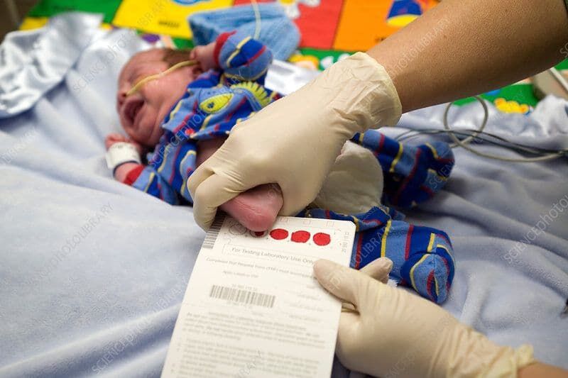 بی اعتنایی نیمی از  والدین به آزمایش خون ابتلا به فنیل‌کتونوری نوزادان 
