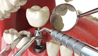 ایمپلنت دندان در «ایمپلنتیا»